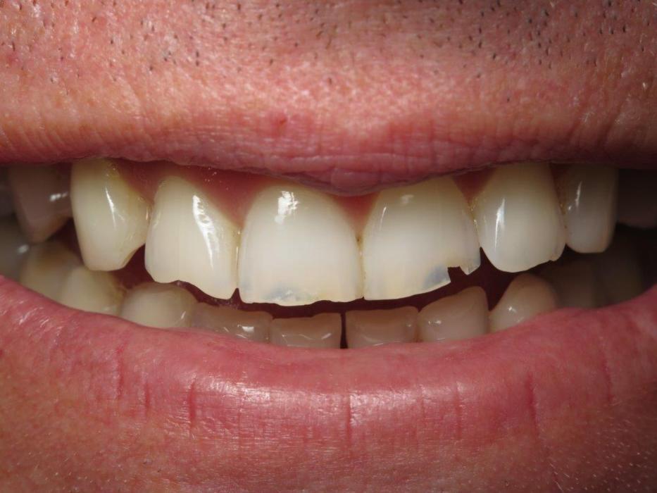 Patient before new teeth | Jonesboro ar dentist